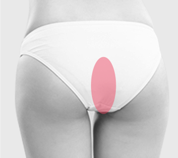 자가 진피 지방 채취 부위를 표시한 이미지