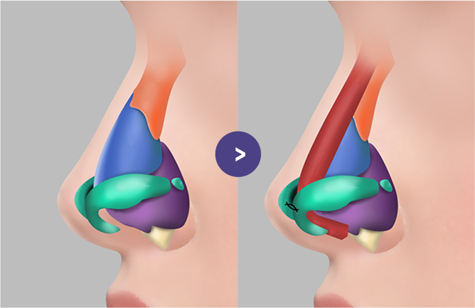늑연골을 이용한 콧대와 코끝연장 수술 전후 구조 설명