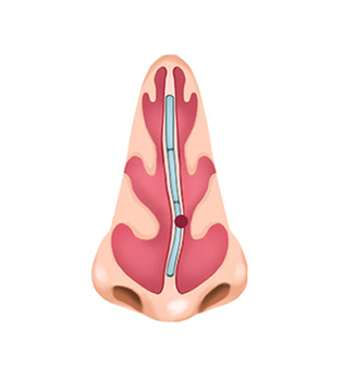 비중격 만곡증 구조를 표현한 코 내부 일러스트
