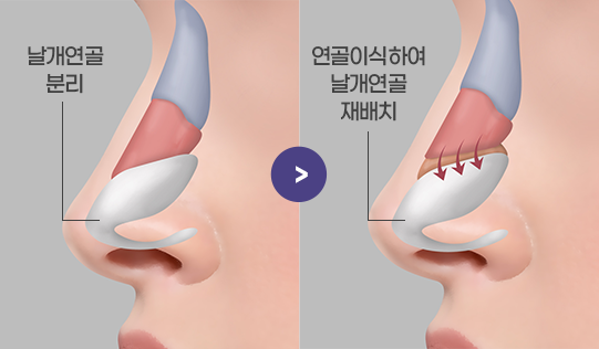 날개연골을 분리하고 재배치하는 수술방법