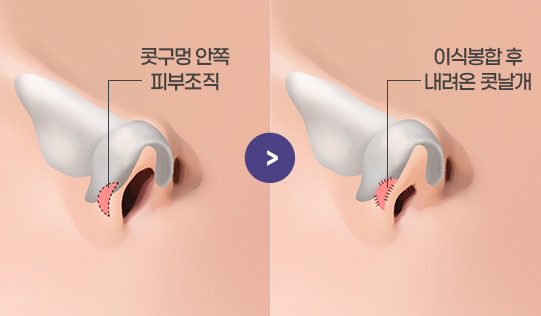 복합조직 이식을 통해 콧날개를 내리는 수술방법