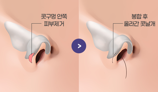 피부를 제거해 콧날개를 올리는 수술방법
