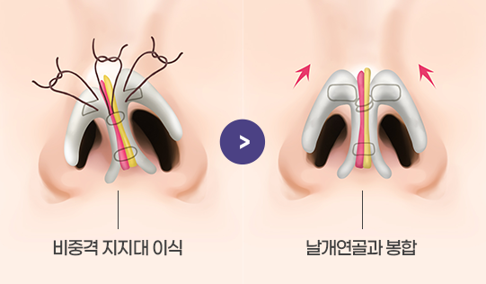 비중격 지지대를 이식해 콧구멍 비대칭을 교정하는 수술방법
