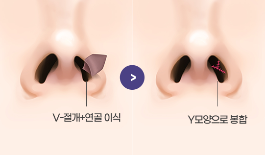 V-Y 피판전진술과 연골이식을 이용한 구축 재수술 방법