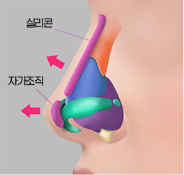 실리콘 또는 자가조직으로 콧대를 세우는 단계