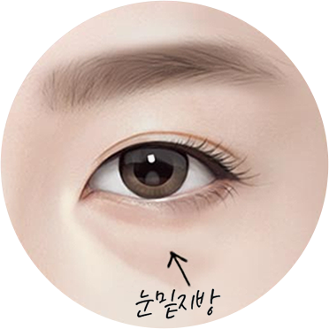 눈밑지방 예시 이미지