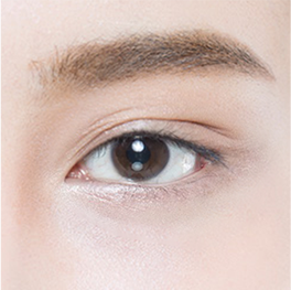 상안검 수술 전 눈 상태
