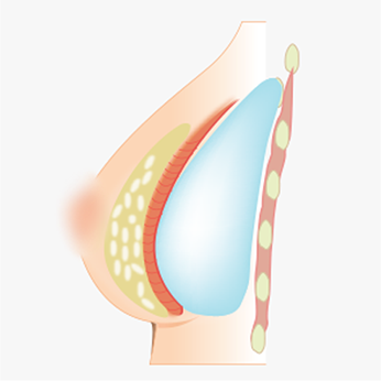 대흉근 아래 보형물 삽입 위치