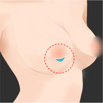 유륜 절개 위치 안내