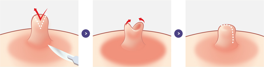 모유 수유가 필요 없는 경우 유두 성형 과정