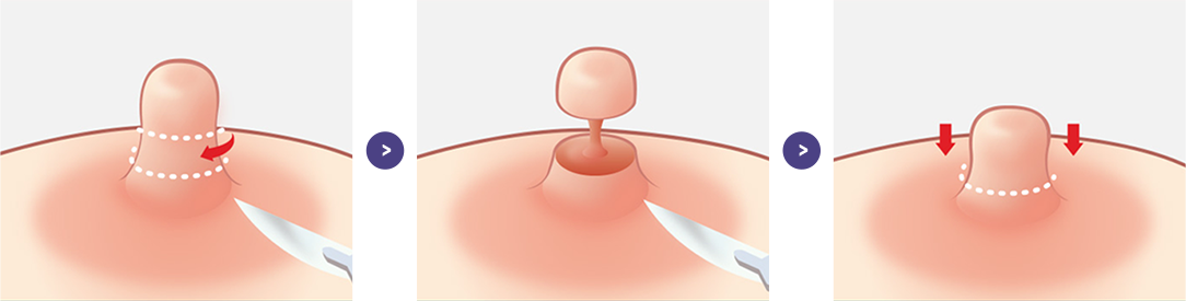 유두의 길이가 긴 경우 수술 과정