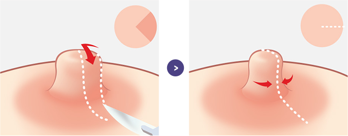 유두의 폭이 넓은 경우 수술 과정